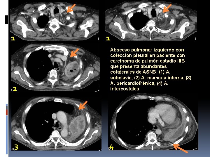 1 2 3 1 Absceso pulmonar izquierdo con colección pleural en paciente con carcinoma