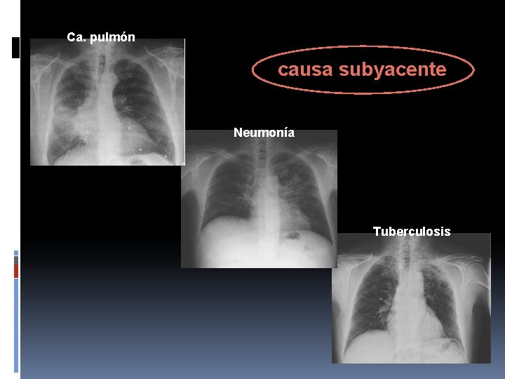 Ca. pulmón causa subyacente Neumonía Tuberculosis 