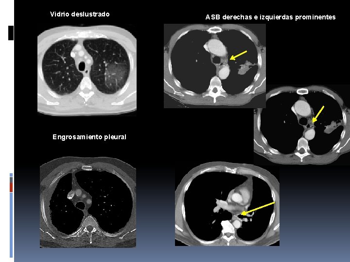 Vidrio deslustrado Engrosamiento pleural ASB derechas e izquierdas prominentes 