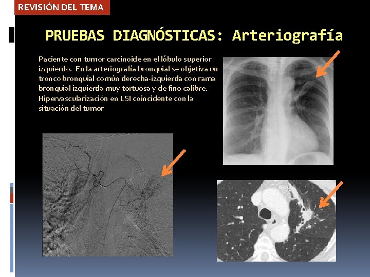 REVISIÓN DEL TEMA PRUEBAS DIAGNÓSTICAS: Arteriografía Paciente con tumor carcinoide en el lóbulo superior