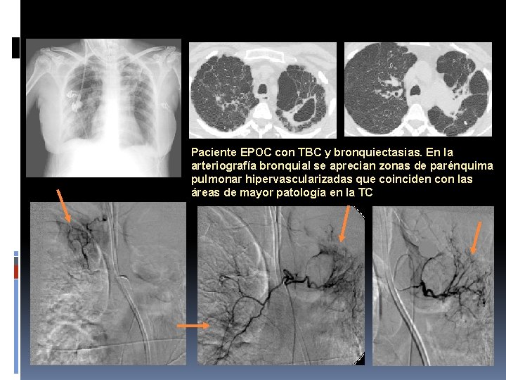 Paciente EPOC con TBC y bronquiectasias. En la arteriografía bronquial se aprecian zonas de