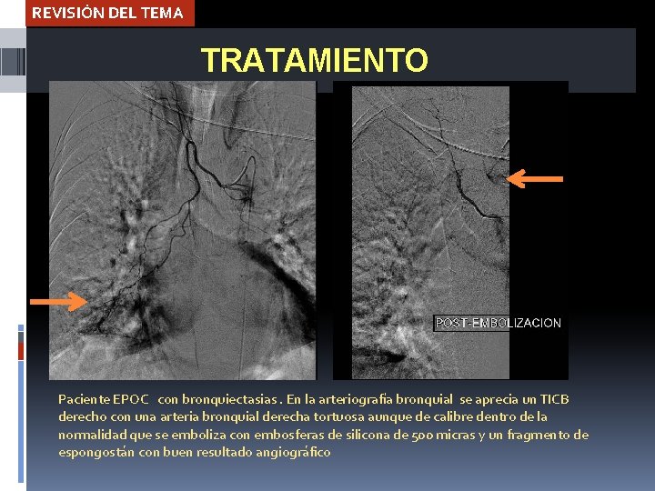 REVISIÓN DEL TEMA TRATAMIENTO Paciente EPOC con bronquiectasias. En la arteriografía bronquial se aprecia