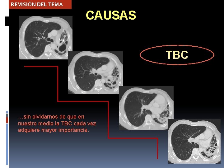 REVISIÓN DEL TEMA CAUSAS TBC …sin olvidarnos de que en nuestro medio la TBC