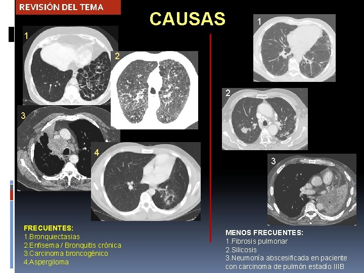 REVISIÓN DEL TEMA CAUSAS 1 1 2 2 3 4 FRECUENTES: 1. Bronquiectasias 2.