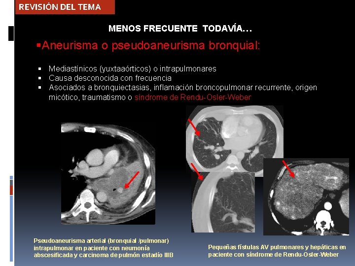REVISIÓN DEL TEMA MENOS FRECUENTE TODAVÍA… Aneurisma o pseudoaneurisma bronquial: Mediastínicos (yuxtaaórticos) o intrapulmonares