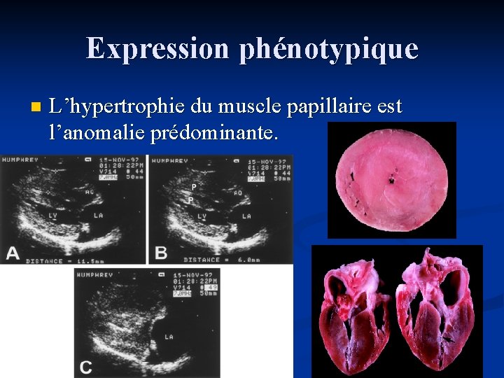 Expression phénotypique n L’hypertrophie du muscle papillaire est l’anomalie prédominante. Expression phénotypique n L’hypertrophie du muscle papillaire est l’anomalie prédominante.