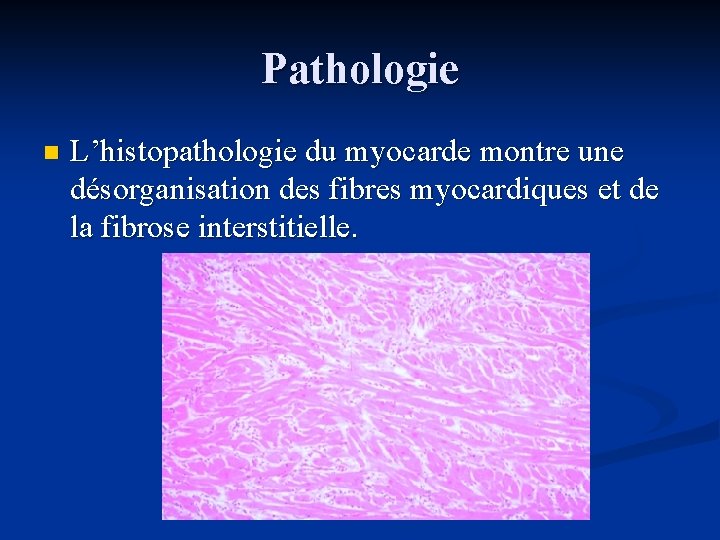 Pathologie n L’histopathologie du myocarde montre une désorganisation des fibres myocardiques et de la