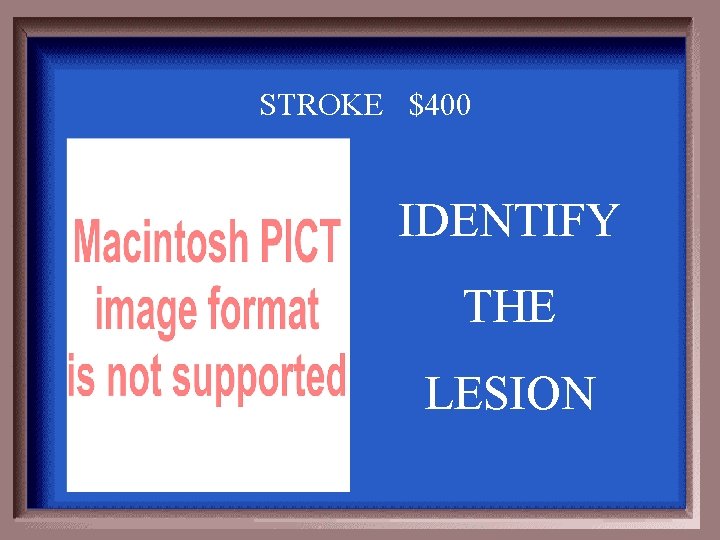 STROKE $400 IDENTIFY THE LESION 