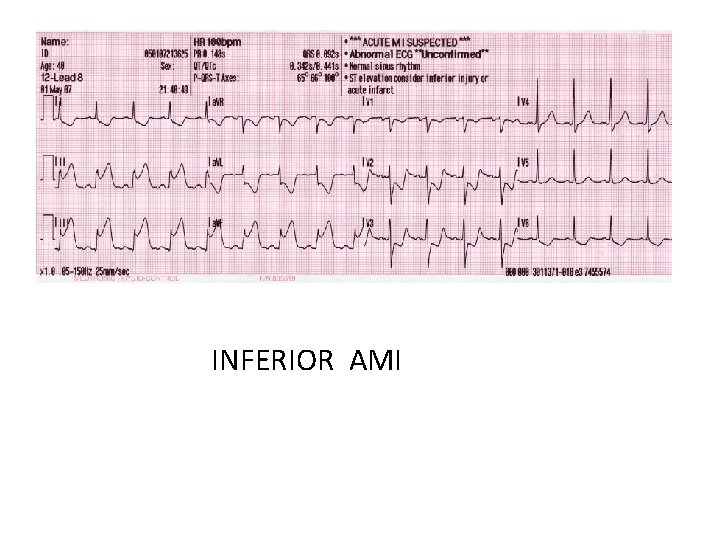 INFERIOR AMI 