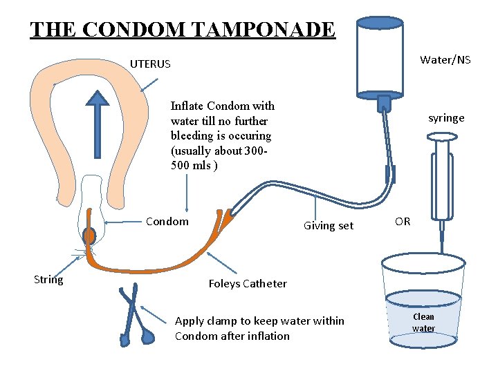 THE CONDOM TAMPONADE Water/NS UTERUS Inflate Condom with water till no further bleeding is