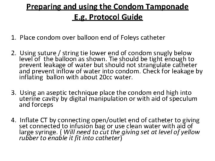 Preparing and using the Condom Tamponade E. g. Protocol Guide 1. Place condom over