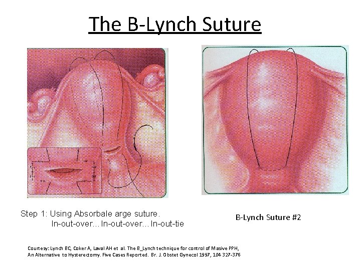 The B-Lynch Suture Step 1: Using Absorbale arge suture. In-out-over…In-out-tie B-Lynch Suture #2 Courtesy: