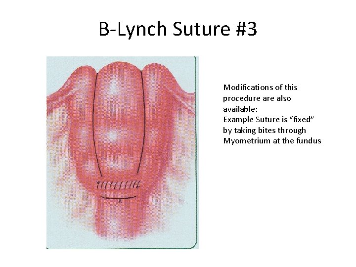 B-Lynch Suture #3 Modifications of this procedure also available: Example Suture is “fixed” by
