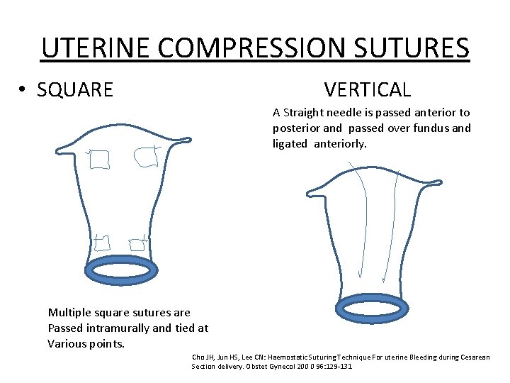 UTERINE COMPRESSION SUTURES • SQUARE VERTICAL A Straight needle is passed anterior to posterior