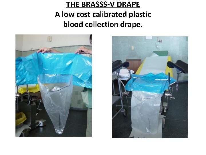 THE BRASSS-V DRAPE A low cost calibrated plastic blood collection drape. 
