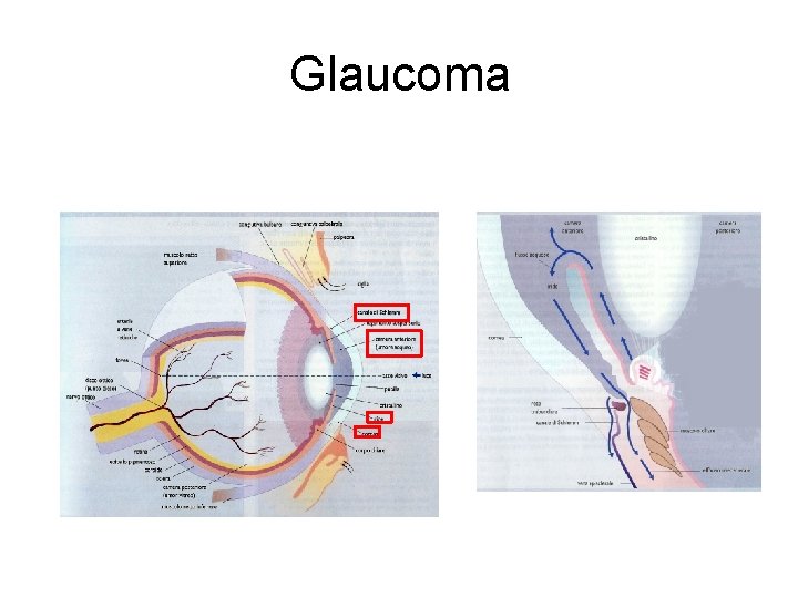 Glaucoma 
