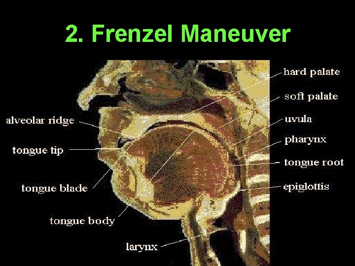 2. Frenzel Maneuver 2. Frenzel Maneuver