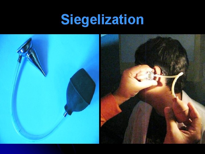 Siegelization Siegelization