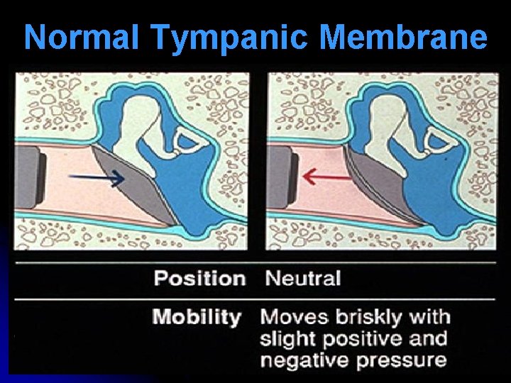 Normal Tympanic Membrane Normal Tympanic Membrane