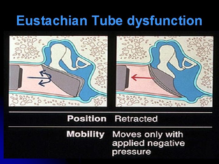 Eustachian Tube dysfunction Eustachian Tube dysfunction