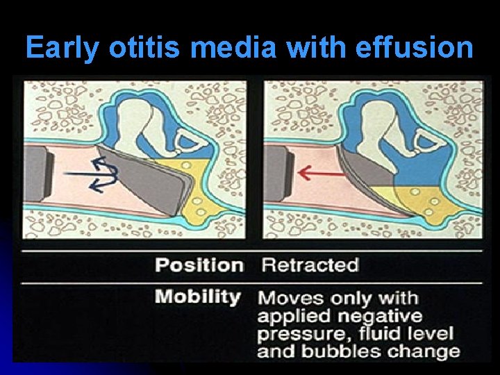 Early otitis media with effusion Early otitis media with effusion
