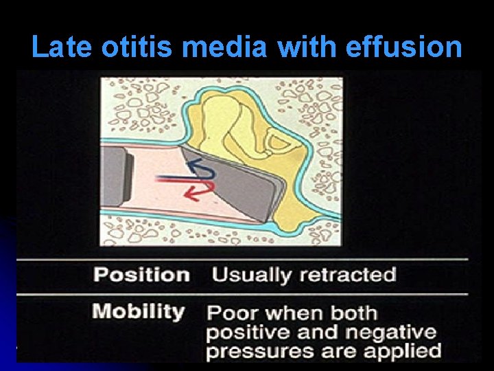 Late otitis media with effusion Late otitis media with effusion