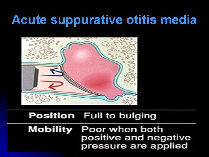 Acute suppurative otitis media Acute suppurative otitis media