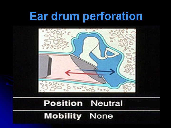 Ear drum perforation Ear drum perforation