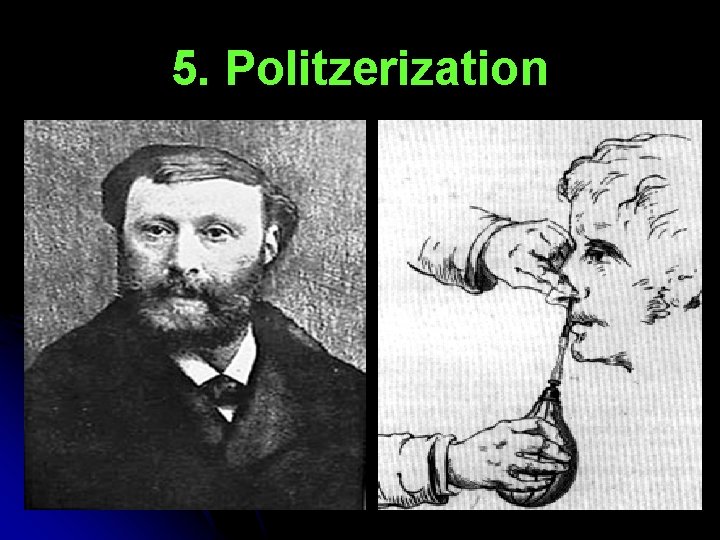 5. Politzerization 5. Politzerization