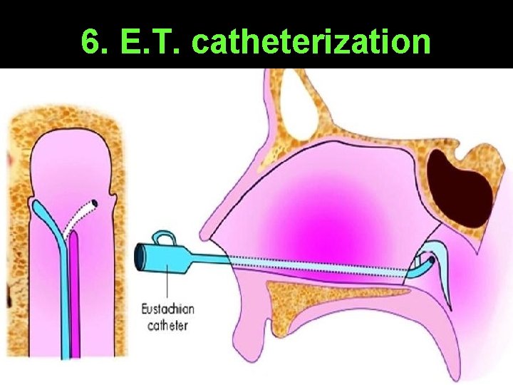 6. E. T. catheterization 6. E. T. catheterization