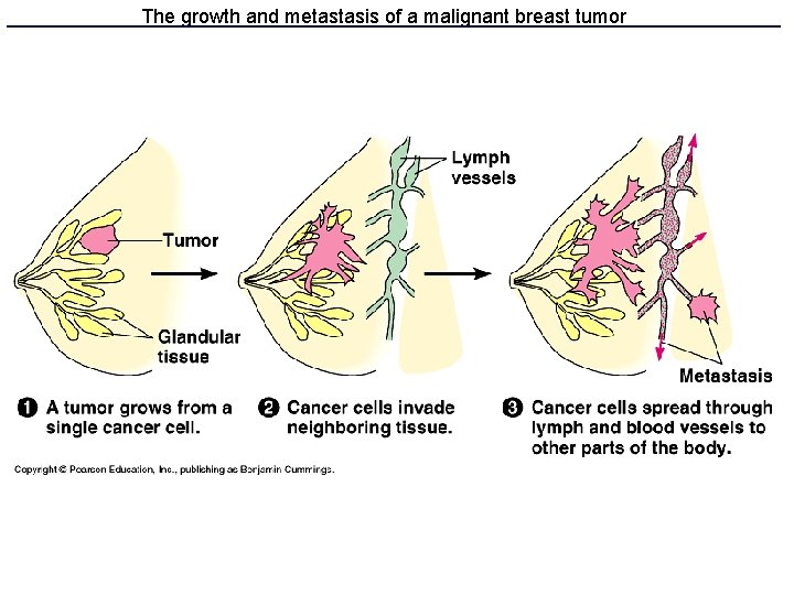 The growth and metastasis of a malignant breast tumor 