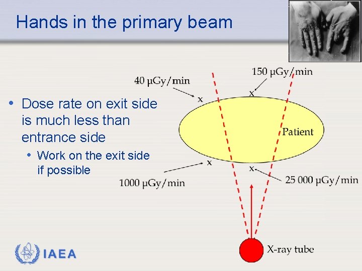 Hands in the primary beam • Dose rate on exit side is much less