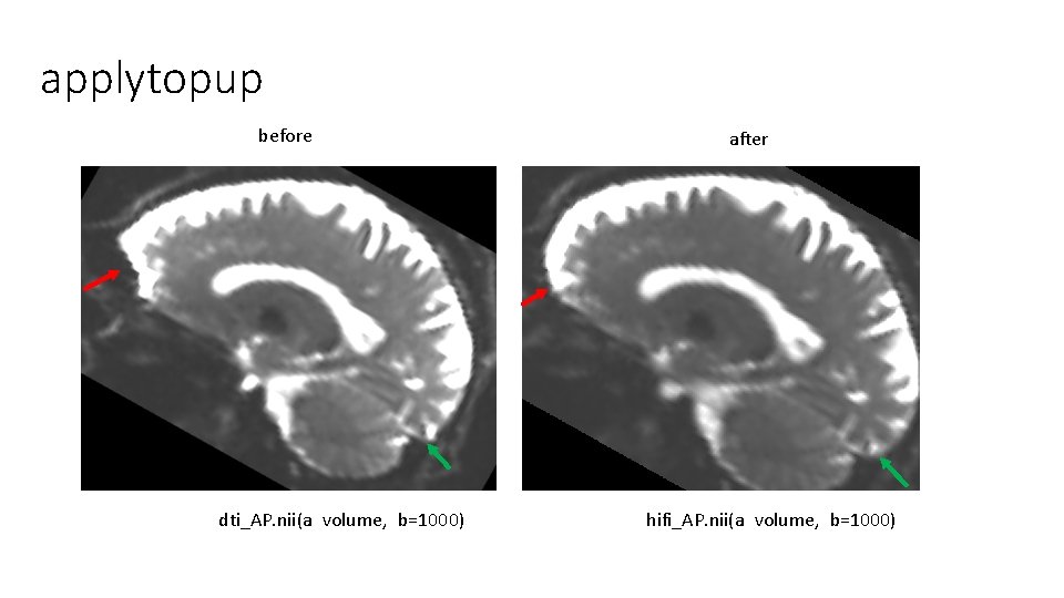 applytopup before dti_AP. nii(a volume, b=1000) after hifi_AP. nii(a volume, b=1000) applytopup before dti_AP. nii(a volume, b=1000) after hifi_AP. nii(a volume, b=1000)
