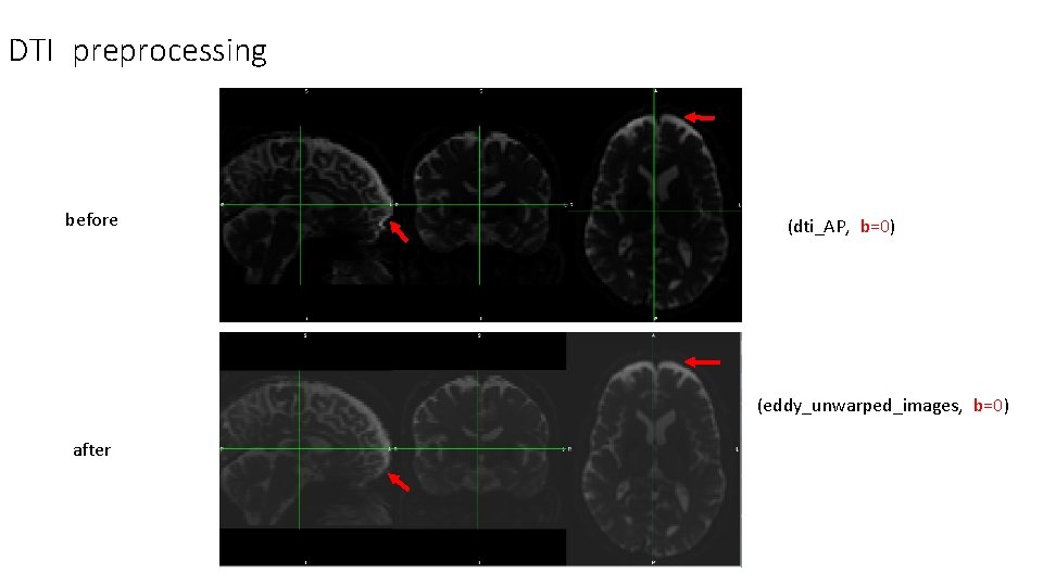 DTI preprocessing before (dti_AP, b=0) (eddy_unwarped_images, b=0) after DTI preprocessing before (dti_AP, b=0) (eddy_unwarped_images, b=0) after