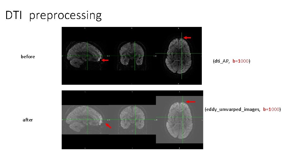 DTI preprocessing before (dti_AP, b=1000) (eddy_unwarped_images, b=1000) after DTI preprocessing before (dti_AP, b=1000) (eddy_unwarped_images, b=1000) after