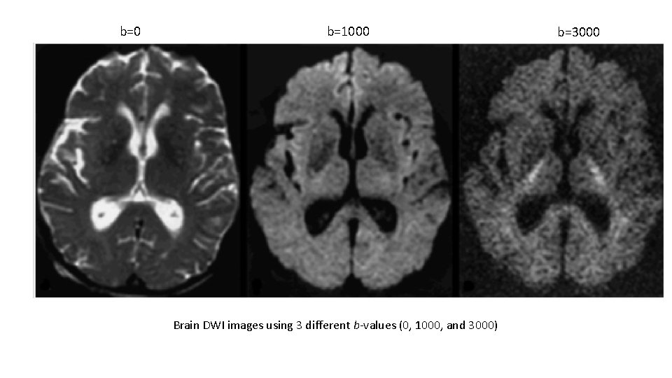 b=0 b=1000 Brain DWI images using 3 different b-values (0, 1000, and 3000) b=3000 b=0 b=1000 Brain DWI images using 3 different b-values (0, 1000, and 3000) b=3000