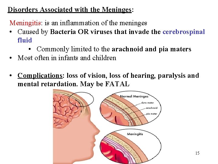 Disorders Associated with the Meninges: Meningitis: is an inflammation of the meninges • Caused