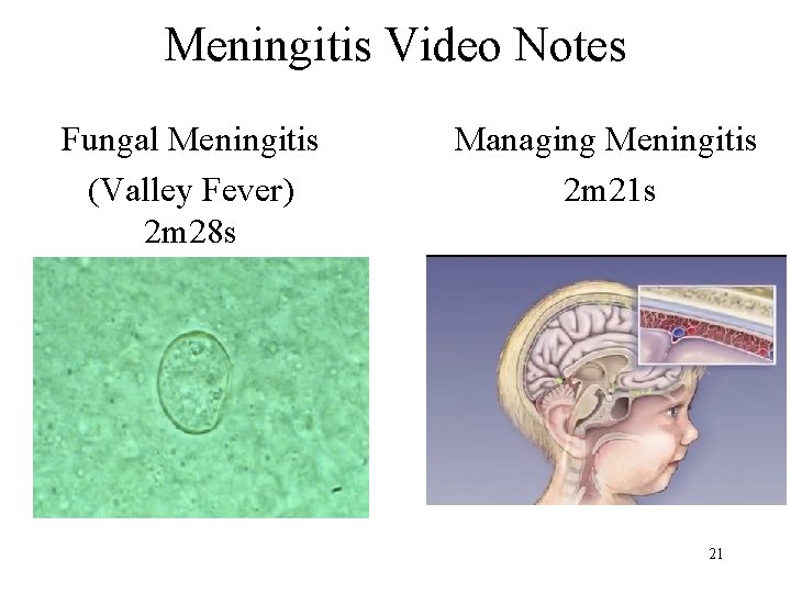 Meningitis Video Notes Fungal Meningitis (Valley Fever) 2 m 28 s Managing Meningitis 2