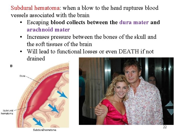 Subdural hematoma: when a blow to the head ruptures blood vessels associated with the