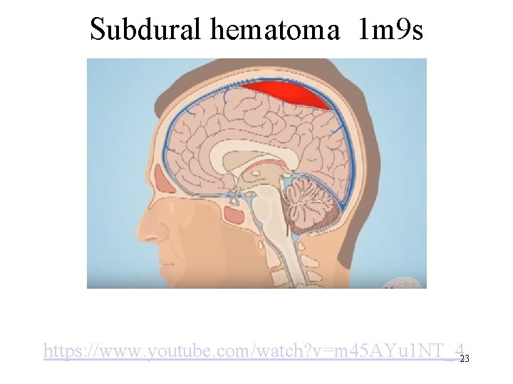 Subdural hematoma 1 m 9 s https: //www. youtube. com/watch? v=m 45 AYu 1