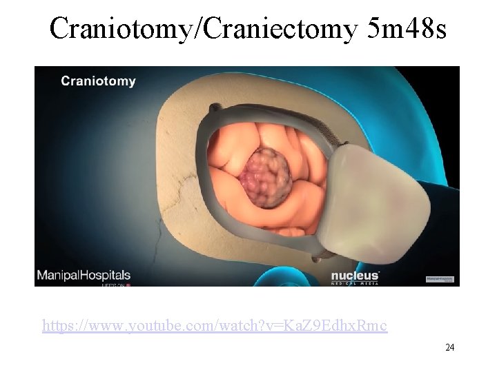 Craniotomy/Craniectomy 5 m 48 s https: //www. youtube. com/watch? v=Ka. Z 9 Edhx. Rmc