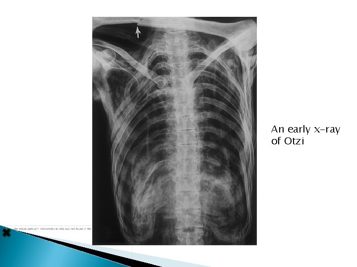 An early x-ray of Otzi 