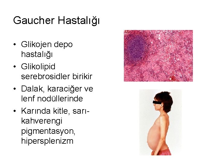 Gaucher Hastalığı • Glikojen depo hastalığı • Glikolipid serebrosidler birikir • Dalak, karaciğer ve