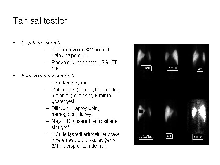 Tanısal testler • • Boyutu incelemek – Fizik muayene: %2 normal dalak palpe edilir.