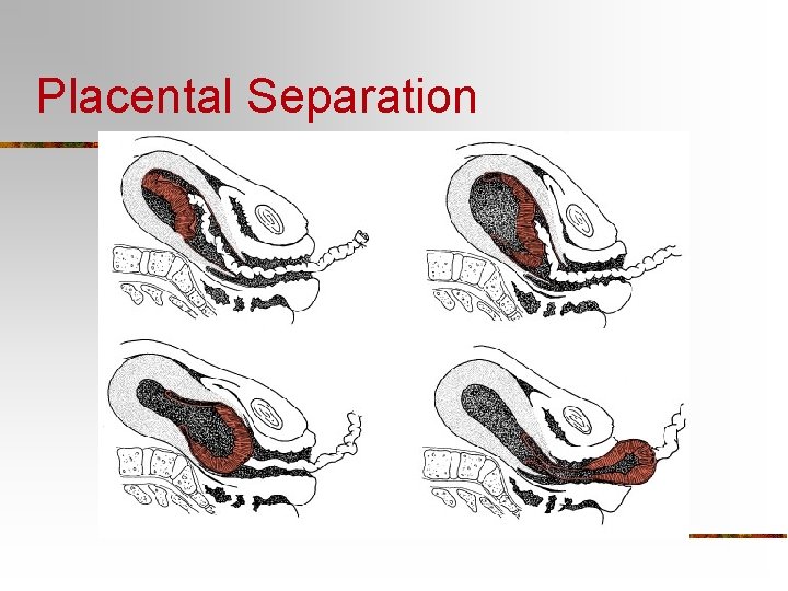 Placental Separation 