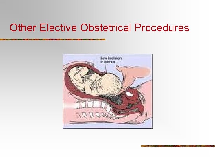 Other Elective Obstetrical Procedures 