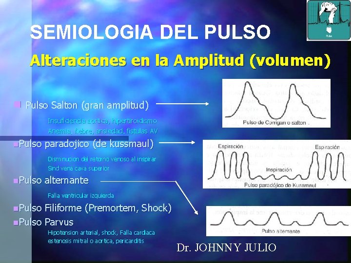 SEMIOLOGIA DEL PULSO Alteraciones en la Amplitud (volumen) n Pulso Salton (gran amplitud) Insuficiencia