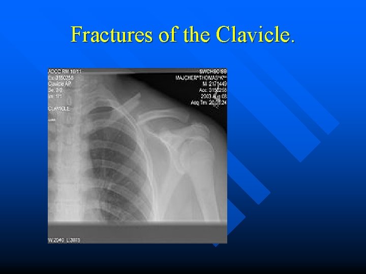 Fractures of the Clavicle. 