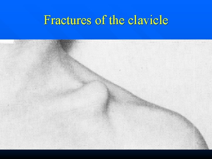 Fractures of the clavicle 