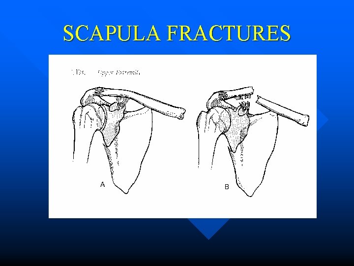 SCAPULA FRACTURES 